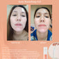 Beautederm Cest Clair Acne Drying Gel Before After Testimonial